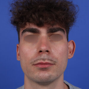 Lire la suite à propos de l’article Otoplastie chez l’adulte : pourquoi de plus en plus de patients sautent le pas ?