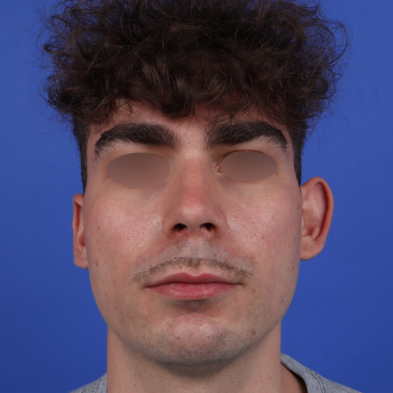 oreilles-décollees-otoplastie-avant-docteur-vairinho2