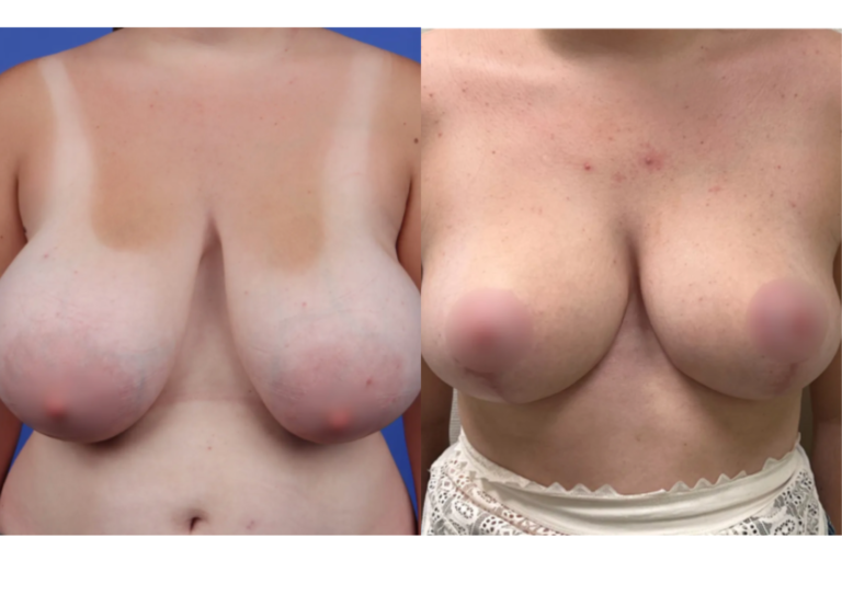 REDUCTION MAMMAIRE AVANT/APRÈS