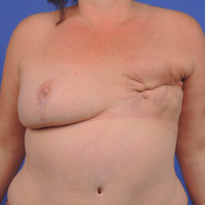 Lire la suite à propos de l’article La chirurgie reconstructrice : retrouver confiance après une mastectomie