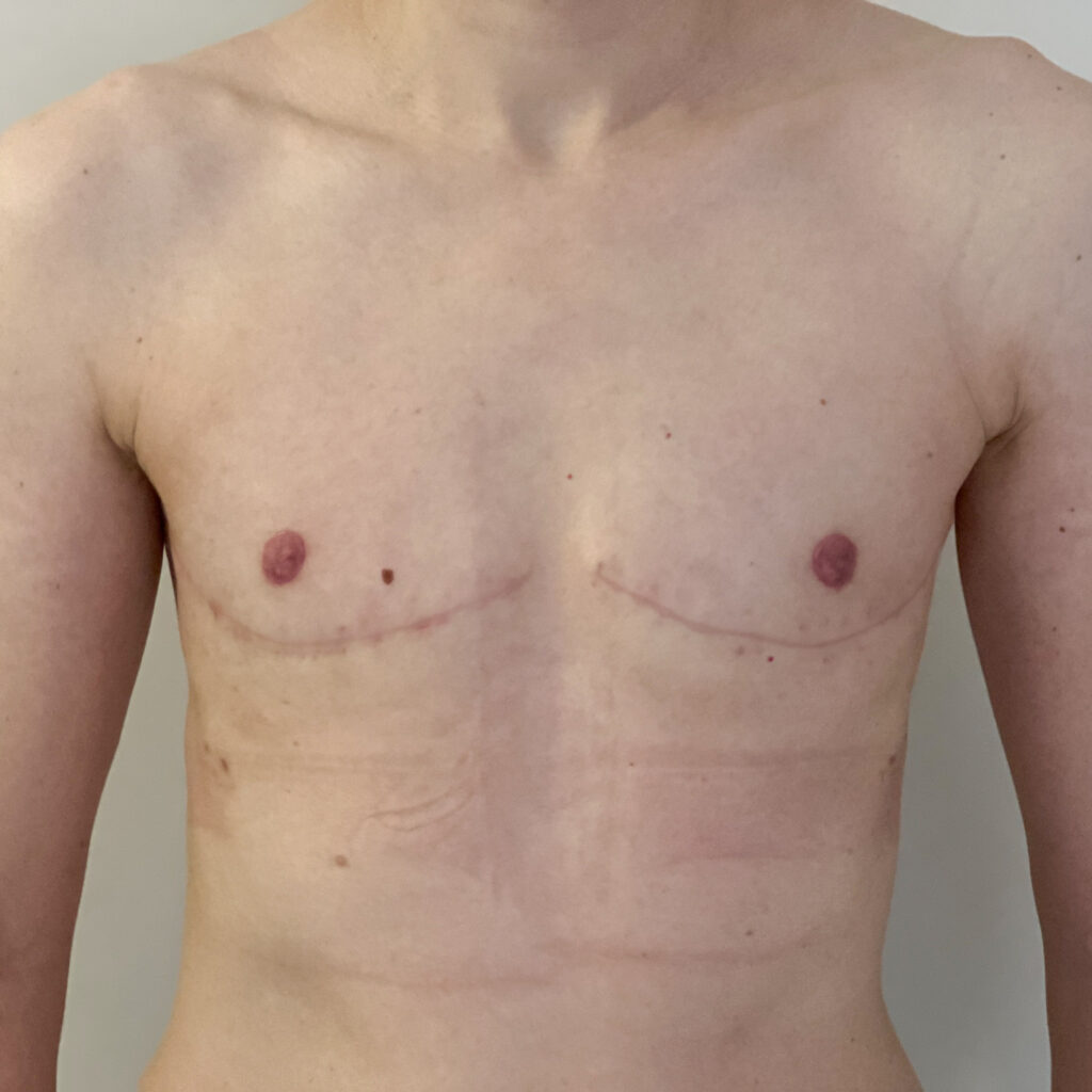 Torsoplastie Docteur Vairinho après résultat