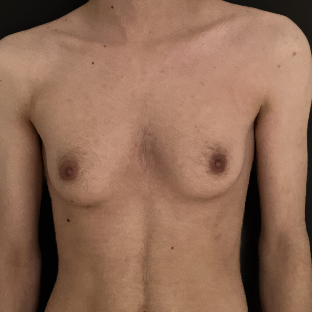 torsoplastie avant docteur vairinho