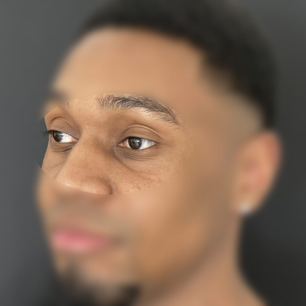 acide hyaluronique poche yeux Docteur Vairinho avant