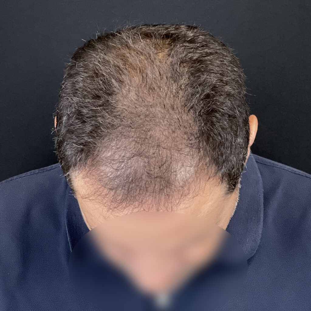 Greffe de cheveux Docteur Vairinho avant