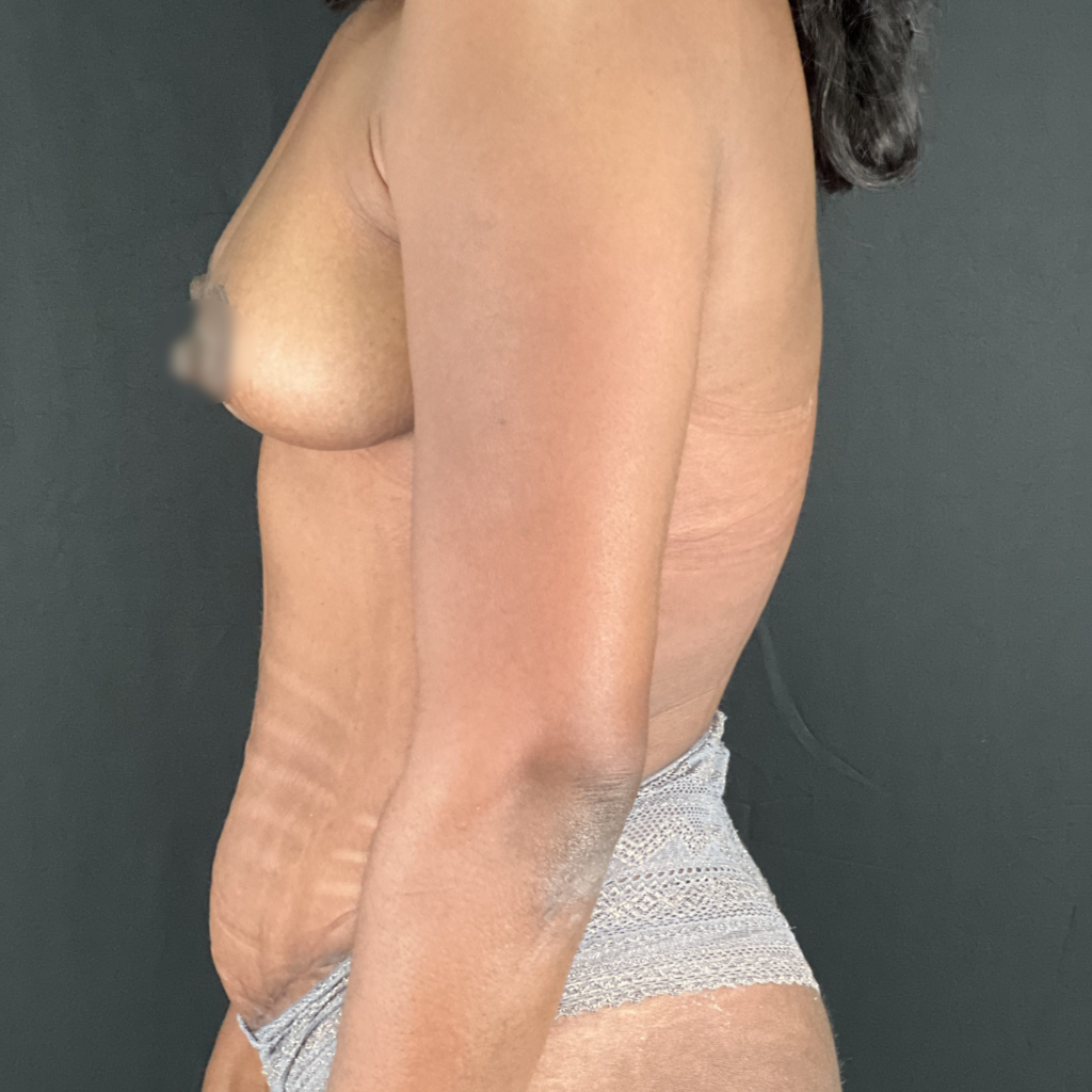 Abdominoplastie résultat après paris docteur vairinho