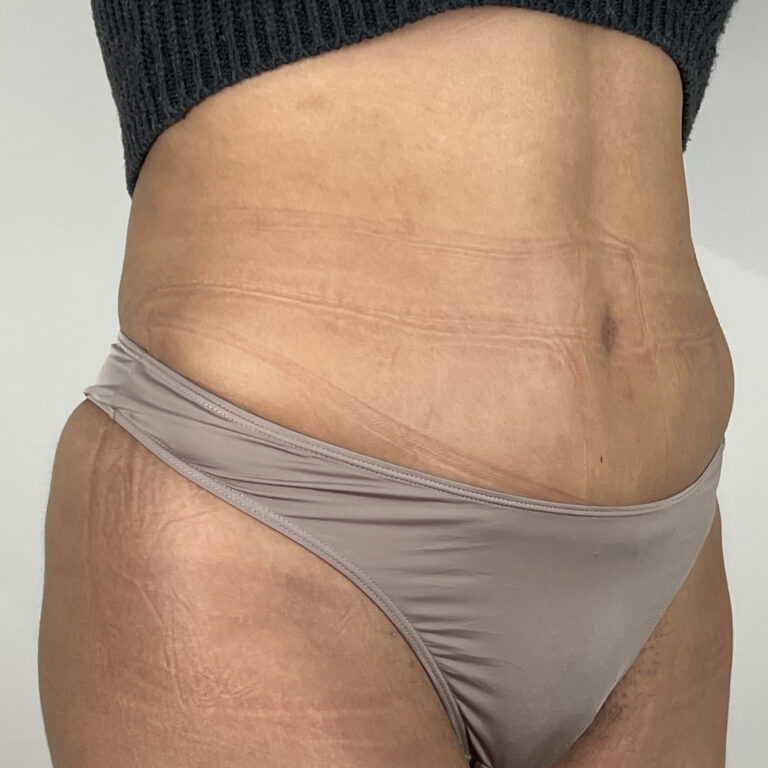 Abdominoplastie 10 après Dr Vairinho Paris