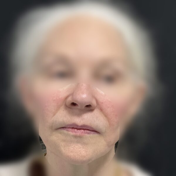 Acide HYALURONIQUE Dr Vairinho Après 4