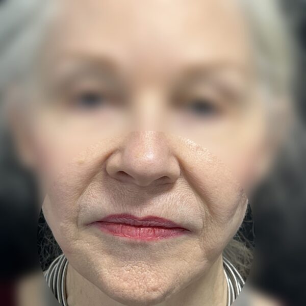 Acide HYALURONIQUE Dr Vairinho Avant 4