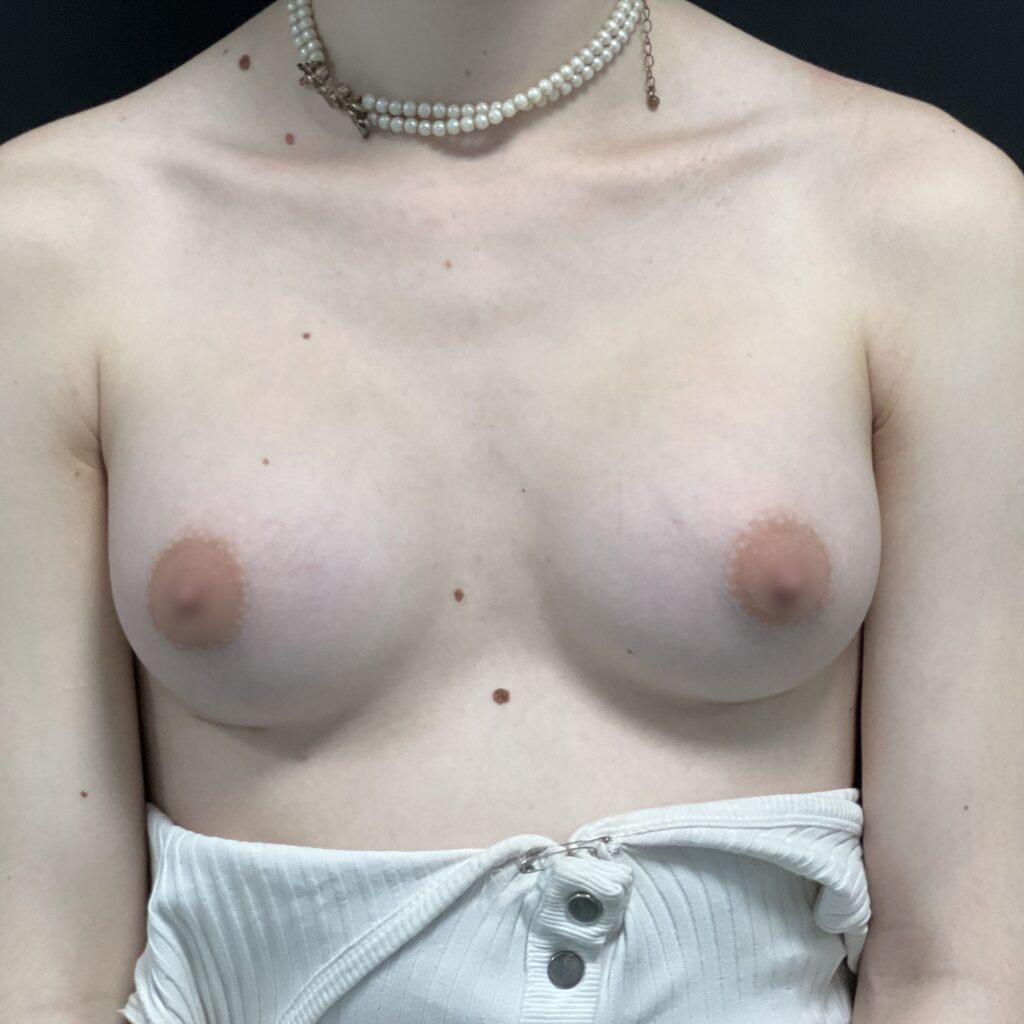 augmentation mammaire prothèses trans après dr vairinho