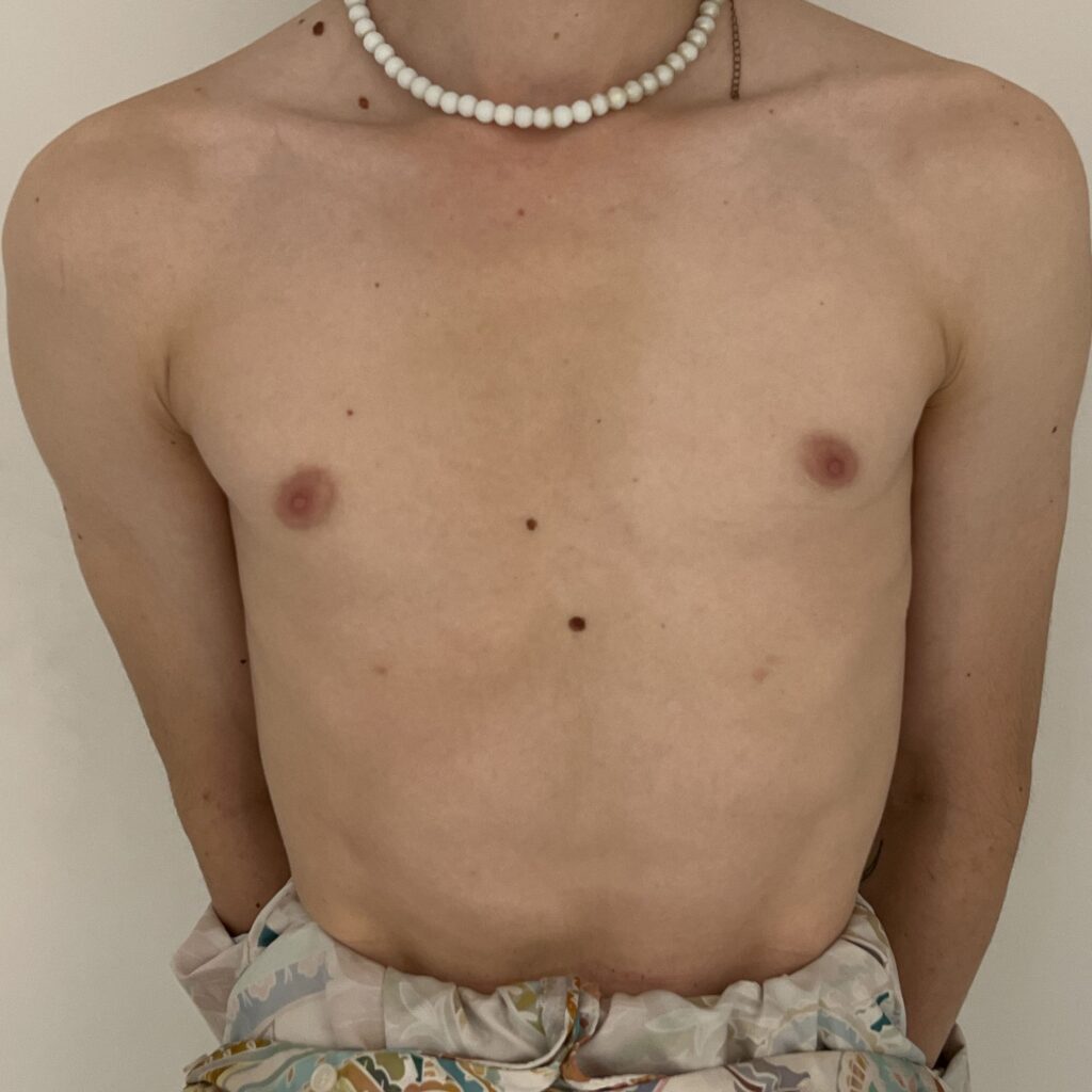 augmentation mammaire prothèses trans avant dr vairinho
