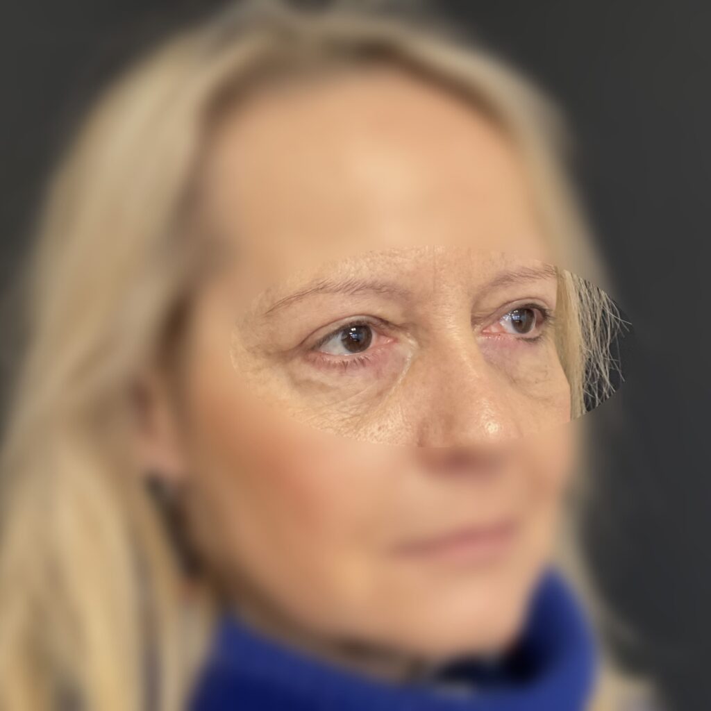 Blépharoplastie Dr Vairinho Après 30 Résultat 2