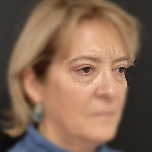 Blépharoplastie Dr Vairinho Après 31 Résultat 2