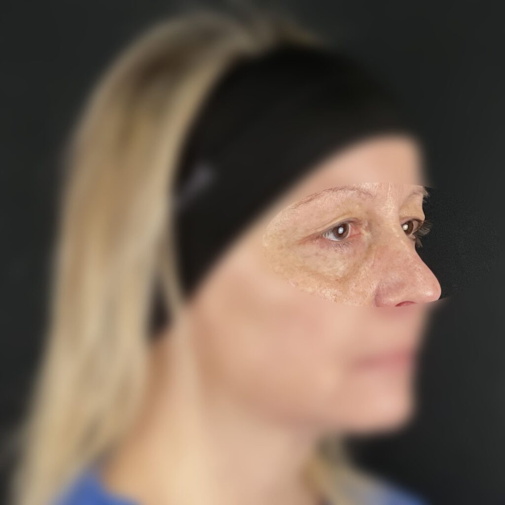 Blépharoplastie Dr Vairinho Avant 30 2