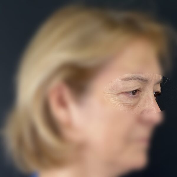 Blépharoplastie Dr Vairinho Avant 31 Résultat 2