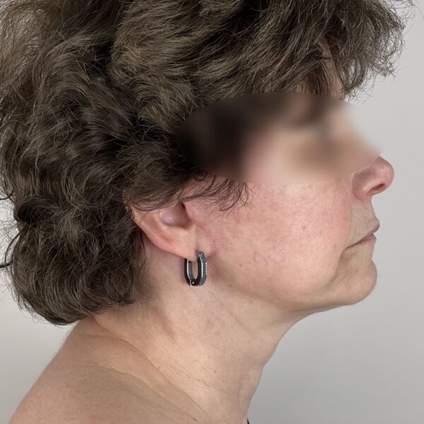 Lifting Après Résultat Dr Vairinho Paris 10