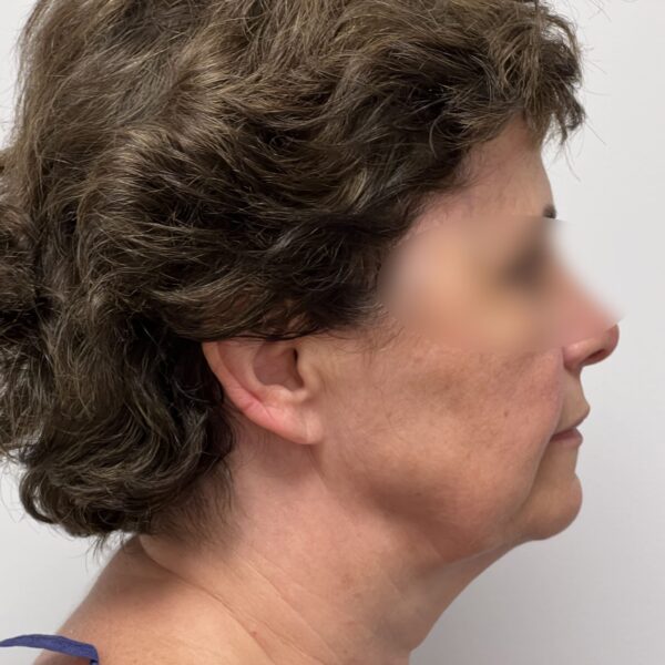 Lifting Avant Dr Vairinho Paris 10