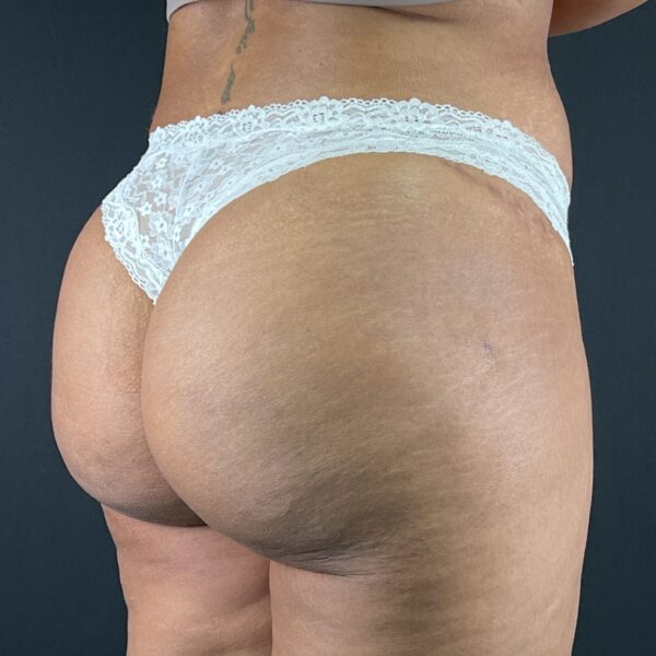 Prothèses fesses Résultat Paris Dr Vairinho 4 Après