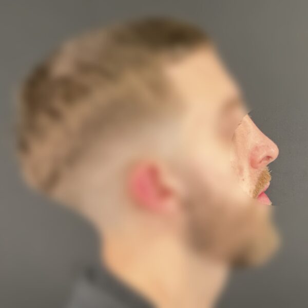 Rhinoplastie Dr Vairinho Paris Après 11