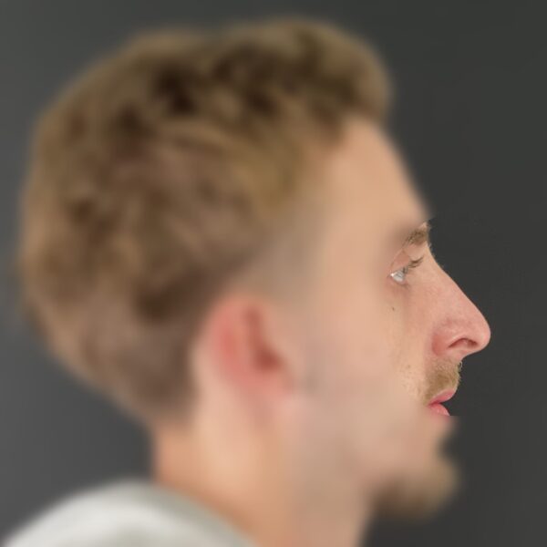 Rhinoplastie Dr Vairinho Paris Avant 11