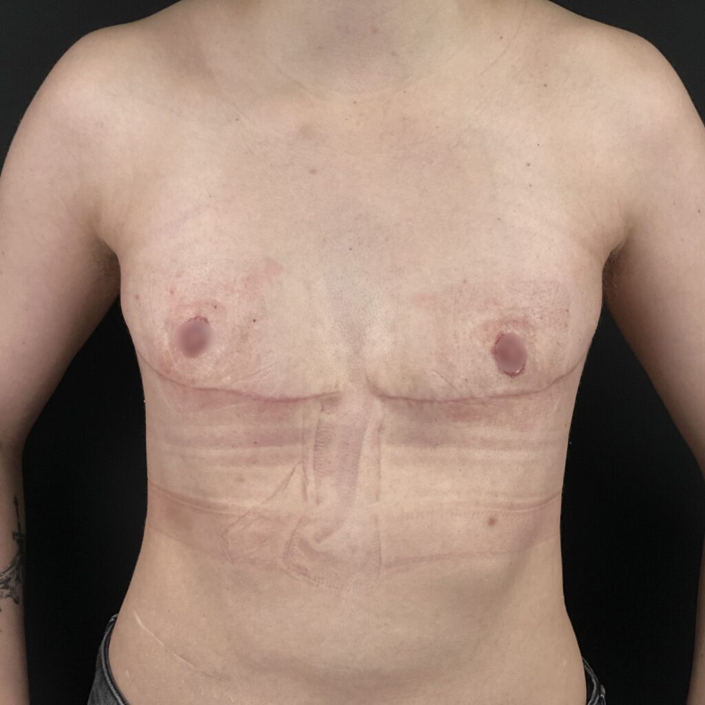 Torsoplastie Dr Vairinho après résultat 30