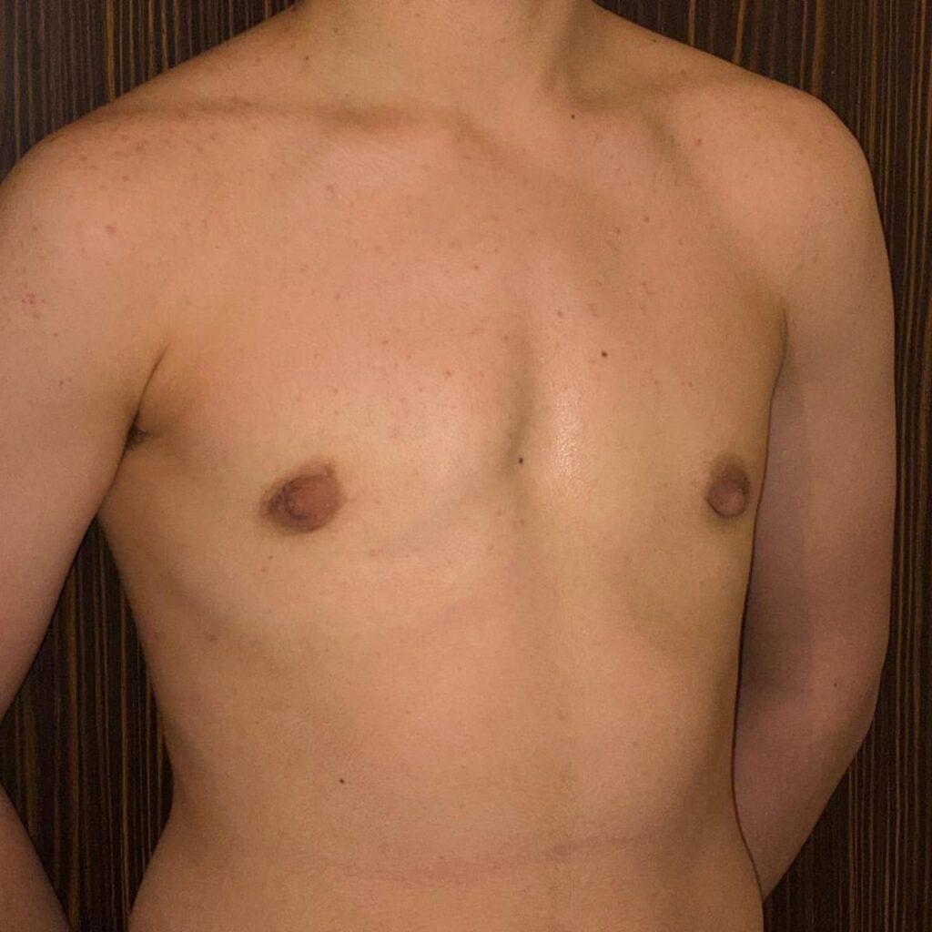 Torsoplastie Dr Vairinho après résultat 31