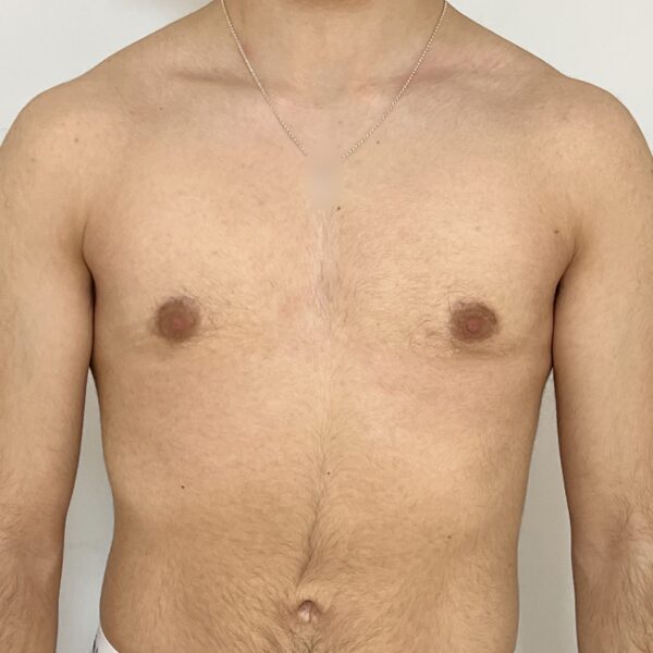 Torsoplastie Dr Vairinho après résultat 32