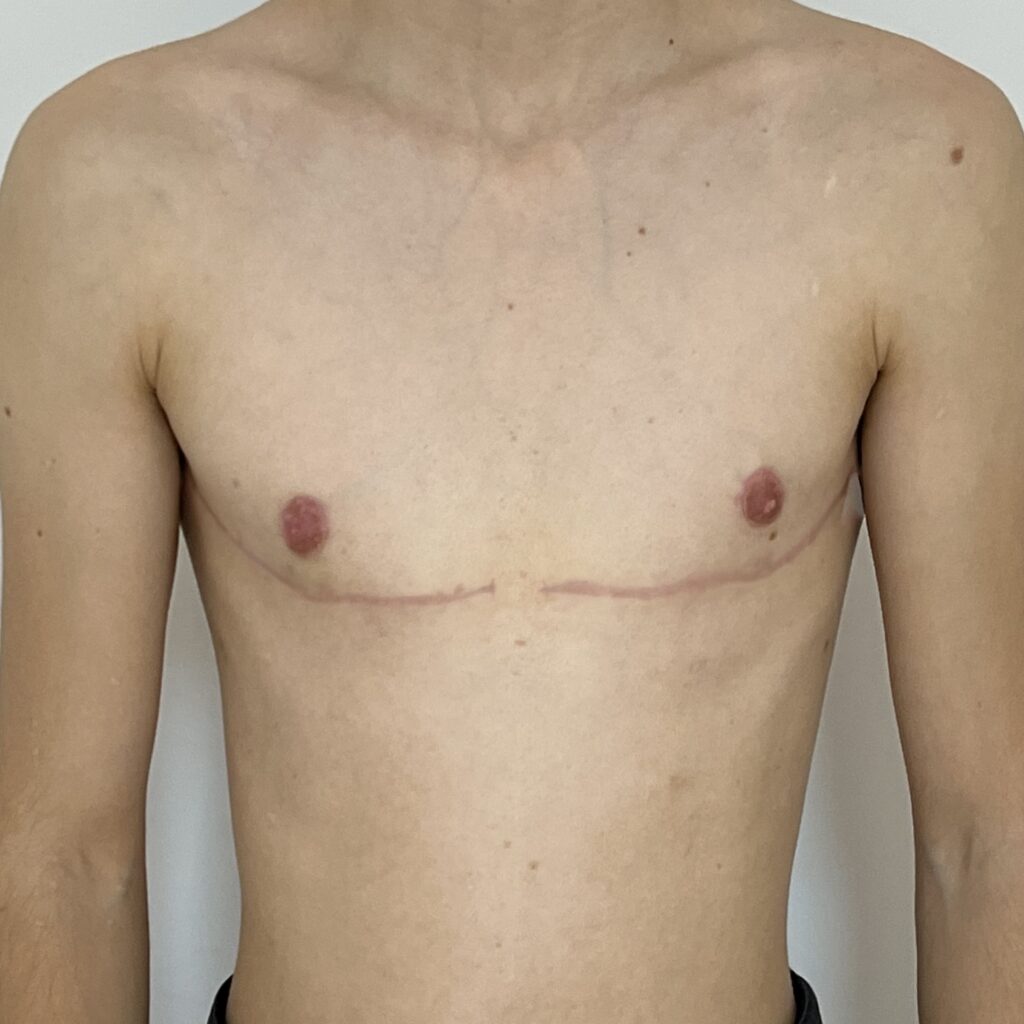 Torsoplastie Dr Vairinho après résultat 33