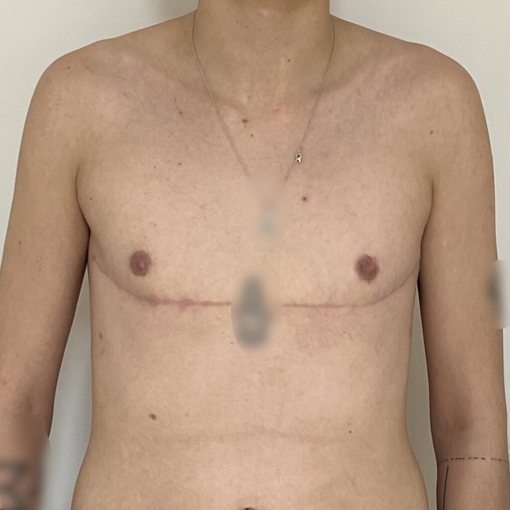 Torsoplastie Dr Vairinho après résultat 34