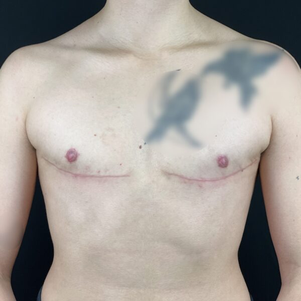 Torsoplastie Dr Vairinho après résultat 35