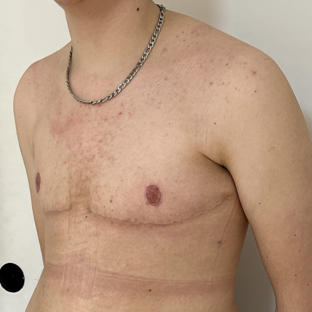 Torsoplastie Dr Vairinho après résultat 36