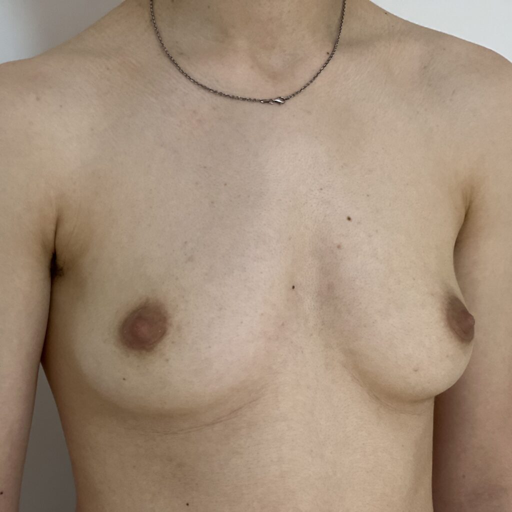 Torsoplastie Dr Vairinho avant 31
