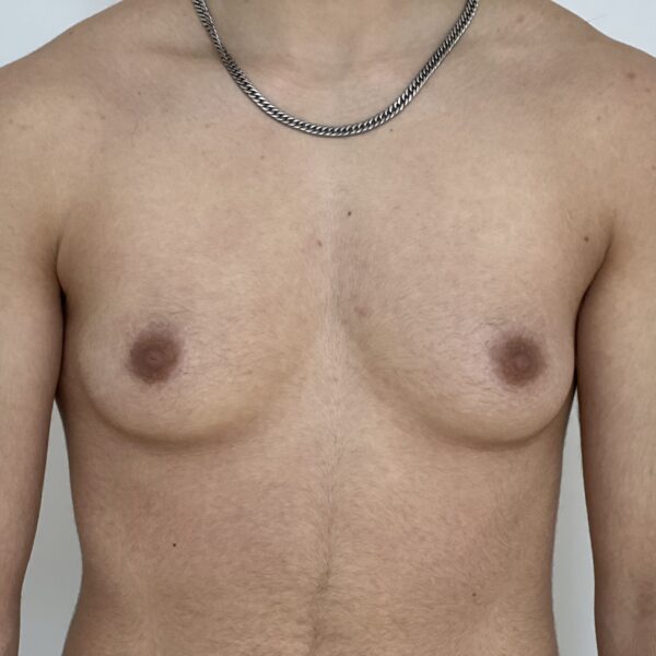 Torsoplastie Dr Vairinho avant 32