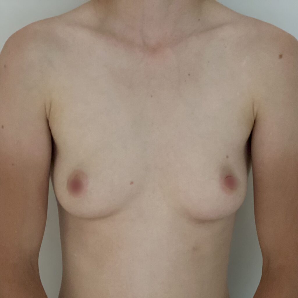 Torsoplastie Dr Vairinho avant 33