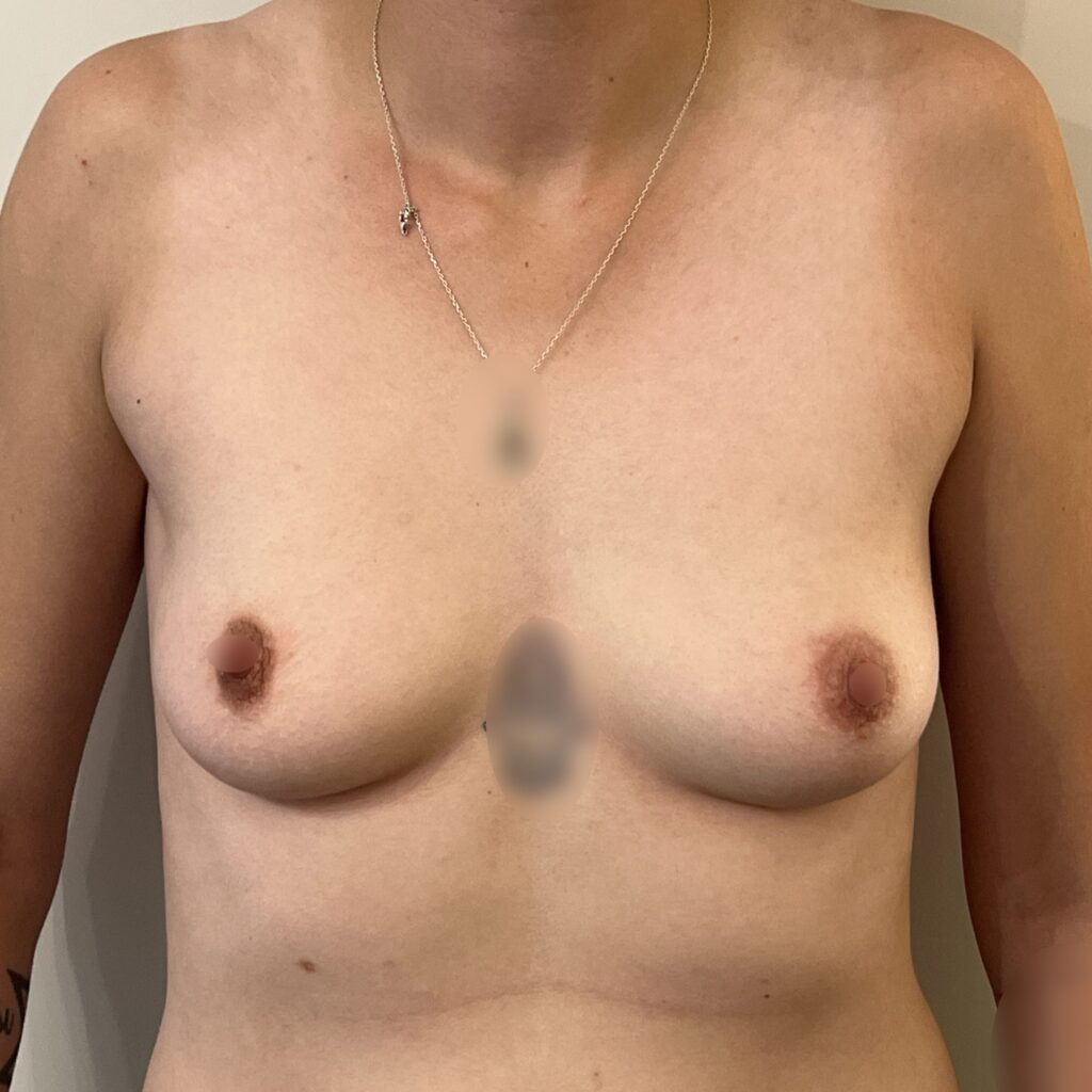 Torsoplastie Dr Vairinho avant 34