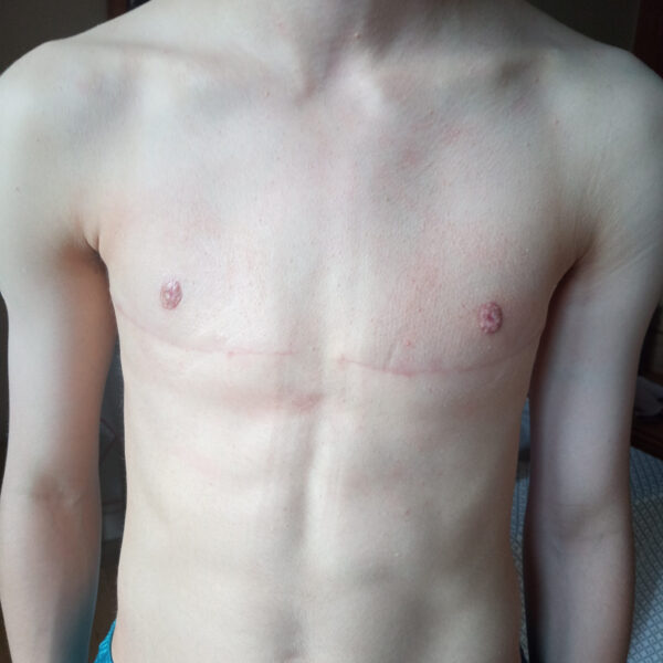 Torsoplastie transidentitaire après paris vairinho