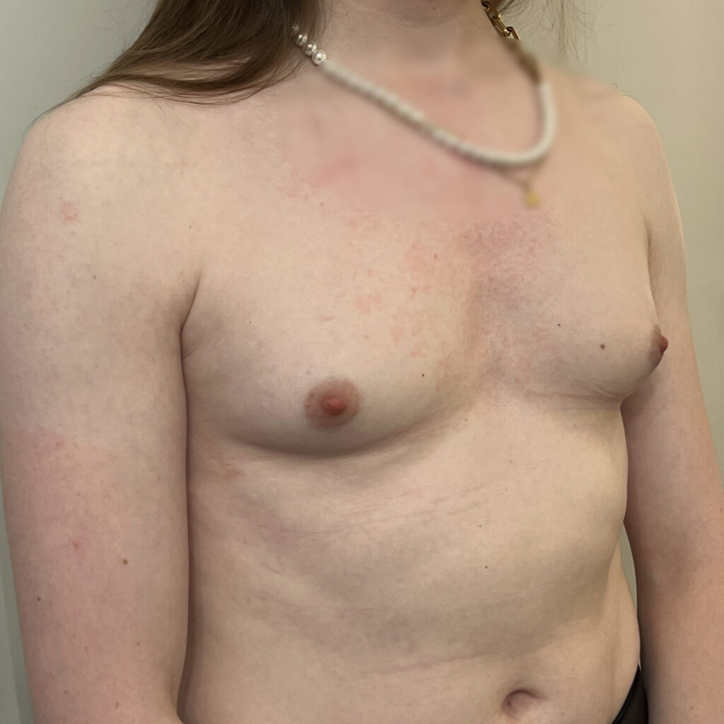 Prothèses mammaires femme trans Docteur Alexandre Vairinho Paris Avant 1000