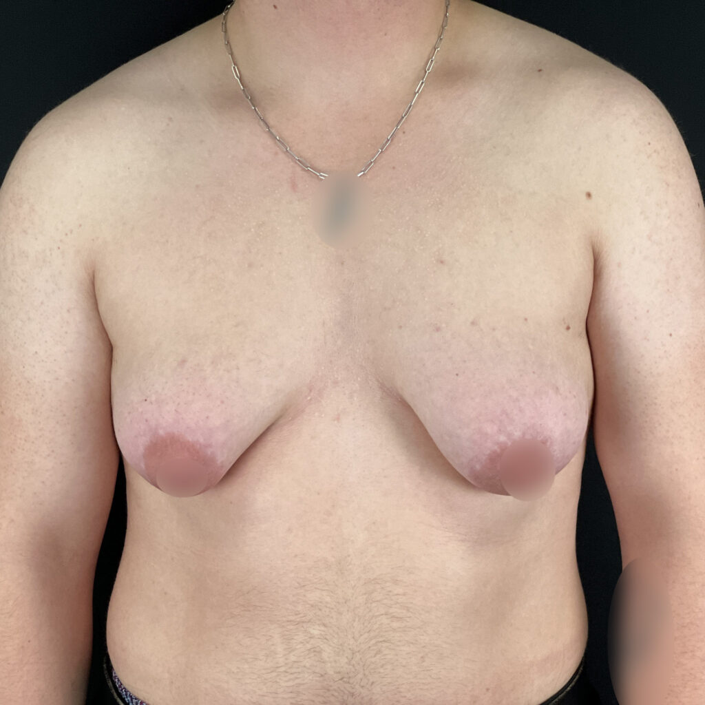 Torsoplastie homme trans Docteur Alexandre Vairinho Paris Avant 10005