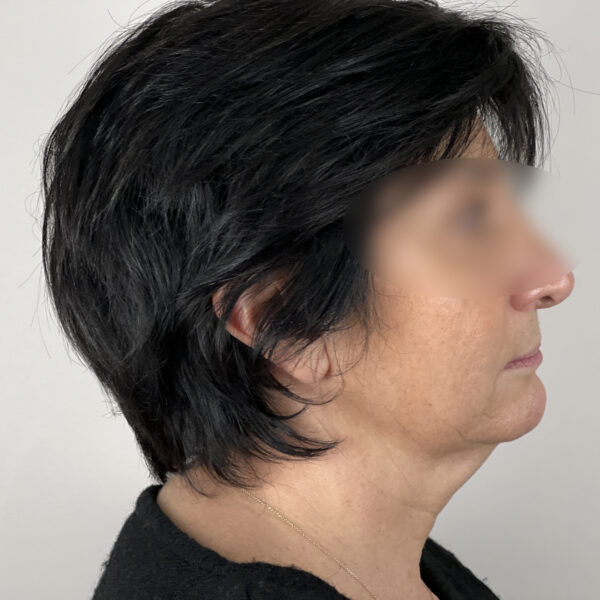 Lifting Docteur Alexandre Vairinho Paris Avant 100