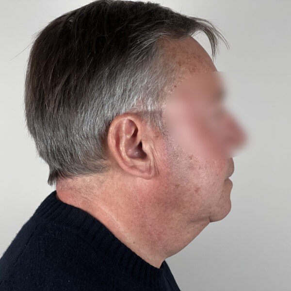 Lifting Docteur Alexandre Vairinho Paris Avant Homme 100