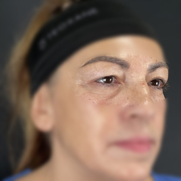 Blépharoplastie Docteur Alexandre Vairinho Paris Avant 100