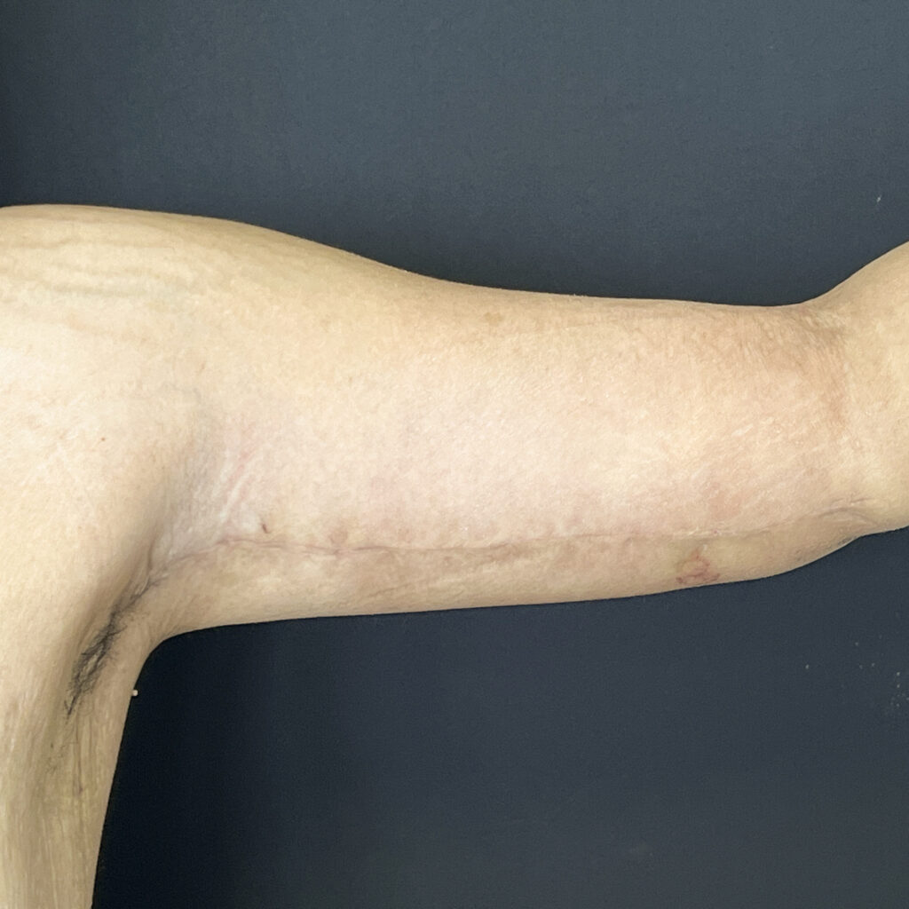 Brachioplastie Docteur Alexandre Vairinho Paris Après 100