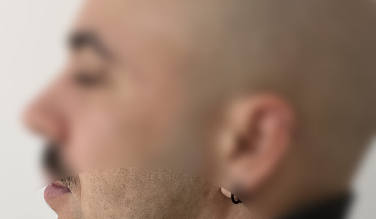 Injections acide hyaluronique Docteur Alexandre Vairinho Paris Résultat Après 1000