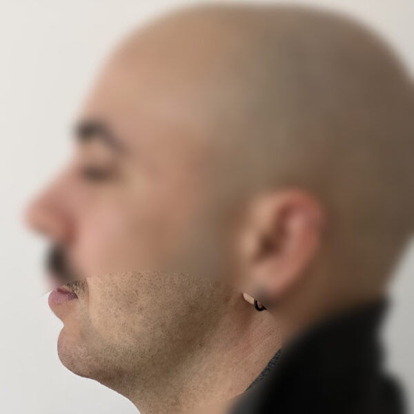 Injections acide hyaluronique Docteur Alexandre Vairinho Paris Résultat Après 1000