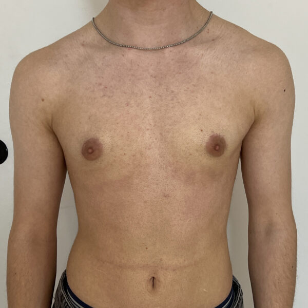 Torsoplastie homme trans Docteur Alexandre Vairinho Paris Après Résultat 10004