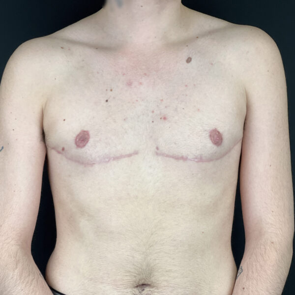 Torsoplastie homme trans Docteur Alexandre Vairinho Paris Après Résultat 10001