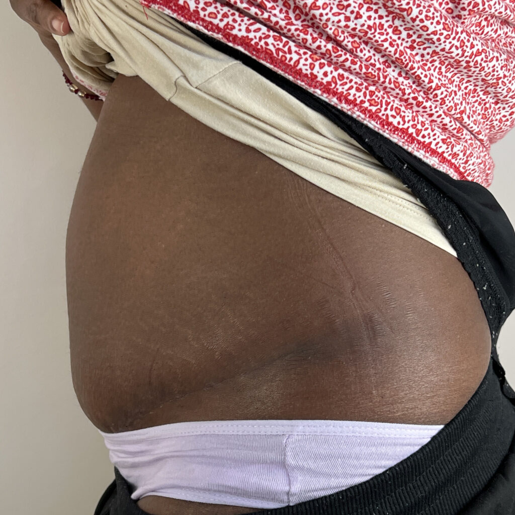 Abdominoplastie Docteur Alexandre Vairinho Paris Après 100