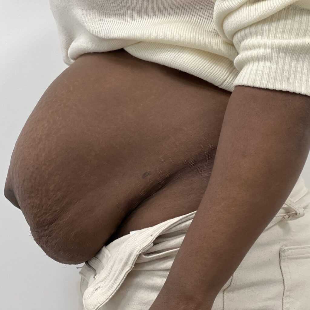 Abdominoplastie Docteur Alexandre Vairinho Paris Avant 100