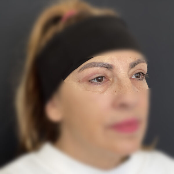 Blépharoplastie Docteur Alexandre Vairinho Paris Après Résultat 100