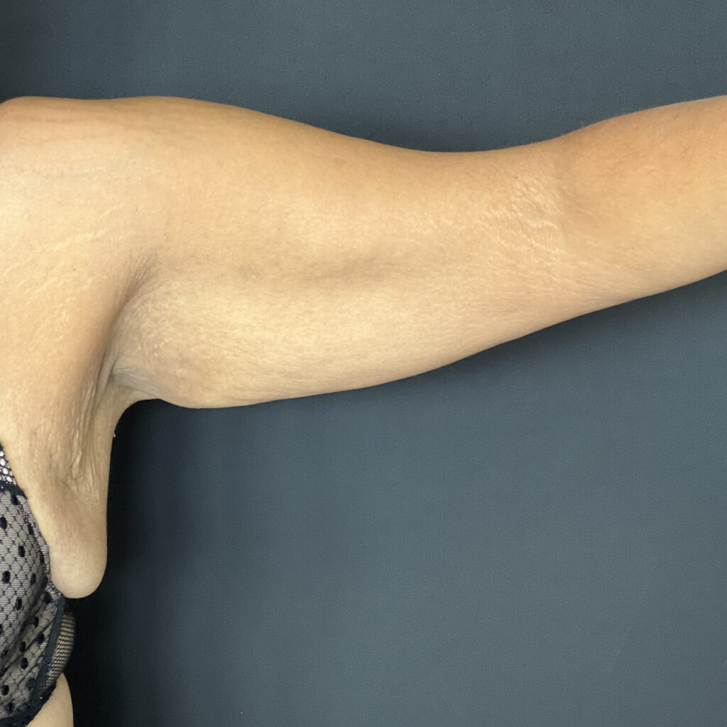 Brachioplastie Docteur Alexandre Vairinho Paris Avant 100
