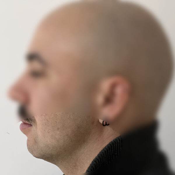 Injections acide hyaluronique Docteur Alexandre Vairinho Paris Avant 1000